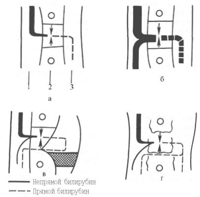 Патогенез билирубинемий при различных патологических состояниях