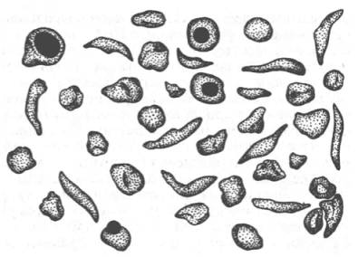 Нормальные и серповидные эритроциты